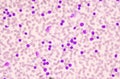 Moderate blast cell of white blood cells in blood smear