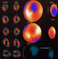 Moderate myocardial ischemia image