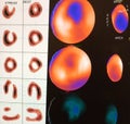 Scintigraphy imaging of a heart