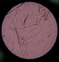 Moderate Uric acid crystal needle shape.