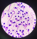 Moderate white blood cells in specimen Synovail fluid