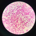 Moderate white blood cells in specimen Synovail fluid