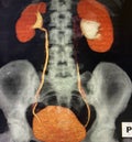 Modern ct scan of renal hydronephrosis pathology Royalty Free Stock Photo
