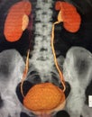 Modern ct scan of renal hydronephrosis pathology