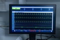 Modern equipment with vital signs monitors in operating room of contemporary clinic. Cardiogram signal monitoring process. The