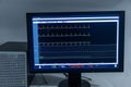 Modern equipment with vital signs monitors in operating room of contemporary clinic. Cardiogram signal monitoring process. The