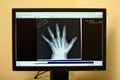 Modern x-ray display of human hand