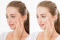 Before-after moisturizing cream. Closeup problem skin portrait Beautiful caucasian woman. Dark circles under eyes, eye bags. Anti