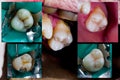 Molar dental treatment steps