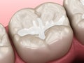 Molar Fissure dental fillings, Medically accurate 3D illustration of dental concept