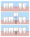 A molar implant on the gum, a infographics with the process of installing a tooth on a metal pin by an orthodontist