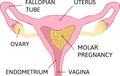 Molar pregnancy, abnormal form of pregnancy. Colored image, white background