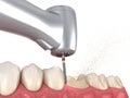 Molar preparation process for dental crown placement. Medically accurate 3D illustration