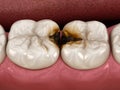 Molar teeth damaged by caries. Medically accurate tooth 3D illustration