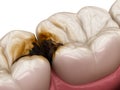 Molar teeth damaged by caries. Medically accurate tooth 3D illustration