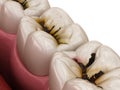 Molar teeth damaged by caries. Medically accurate tooth 3D illustration