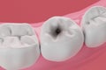 Molar teeth and tooth decay with gums