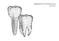 Molar tooth dental implant 3d low poly geometric model. Dentistry innovation future technology titan metal thread