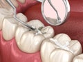 Molar tooth fissure restoration with filling. Medically accurate tooth 3D illustration