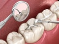 Molar tooth fissure restoration with filling. Medically accurate tooth 3D illustration