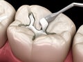 Molar tooth fissure restoration with filling. Medically accurate tooth 3D illustration