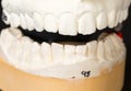 Mold of teeth taken for orthodontics