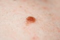 Mole birthmark nevus macro photo on human skin. crochordon or soft fibroma close up