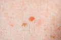 Mole birthmark nevus macro photo on human skin. crochordon or soft fibroma close up