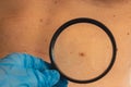 Mole dermoscopy, preventive of melanoma. Dermatologist examining patient's birthmark with magnifying glass in clinic Royalty Free Stock Photo