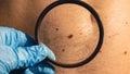 Mole dermoscopy, preventive of melanoma. Dermatologist examining patient& x27;s birthmark with magnifying glass in clinic Royalty Free Stock Photo
