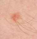 Mole on the human skin. macro Royalty Free Stock Photo