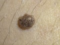 A mole with potential indications of malignant melanoma.