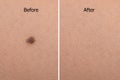 mole on woman skin before after laser treatment