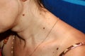 Moles on the neck. Birthmark on the neck.