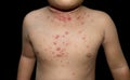 Molluscum contagiosum skin lesions also called water warts