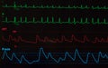 Monitor with Atrial Fibrillation Royalty Free Stock Photo