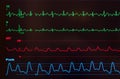 Monitor with Atrial Flutter