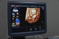 Monitor with baby images in the process of gestation. Royalty Free Stock Photo