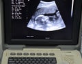 A monitor of a portable ultrasonography showing the head of a fetus with a gestational age GA 18 weeks and 4 days Royalty Free Stock Photo