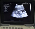 A monitor of a portable ultrasonography showing the head of a fetus with a gestational age GA 18 weeks and 4 days Royalty Free Stock Photo