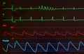 Monitor with Short Run of Ventricular Tachycardia