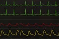 Monitoring displays of patient vital signs