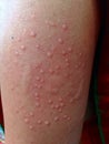 Monkey Pox Virus transmitted in human body