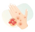 Monkeypox - Skin Rashes and Spots as Symptoms - Icon
