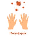 Monkeypox symptoms, hand skin rashes, blisters and purulent formations. Skin disease caused by a virus, chicken pox