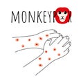 Monkeypox virus symptom doodle concept. Monkey face and hands with rash. Monkey pox script. Viral smallpox disease