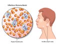 mononucleosis