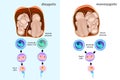 Monozygotic or dizygotic twins.