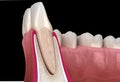 Morphology of maxillary lateral incisor tooth and gum. Medically accurate dental 3D illustration Royalty Free Stock Photo