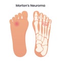 Morton\'s Neuroma medical educational vector illustration graphic
